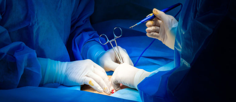 Urologists' hands operating on the patient doing a vasectomy reversal